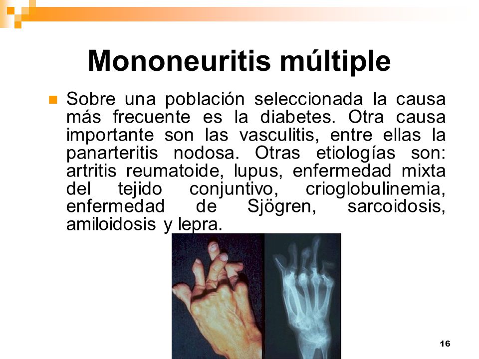 mononeuritis multiple